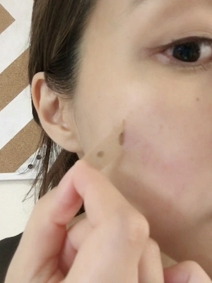 シミ取りレーザーで顔のシミを除去した画像